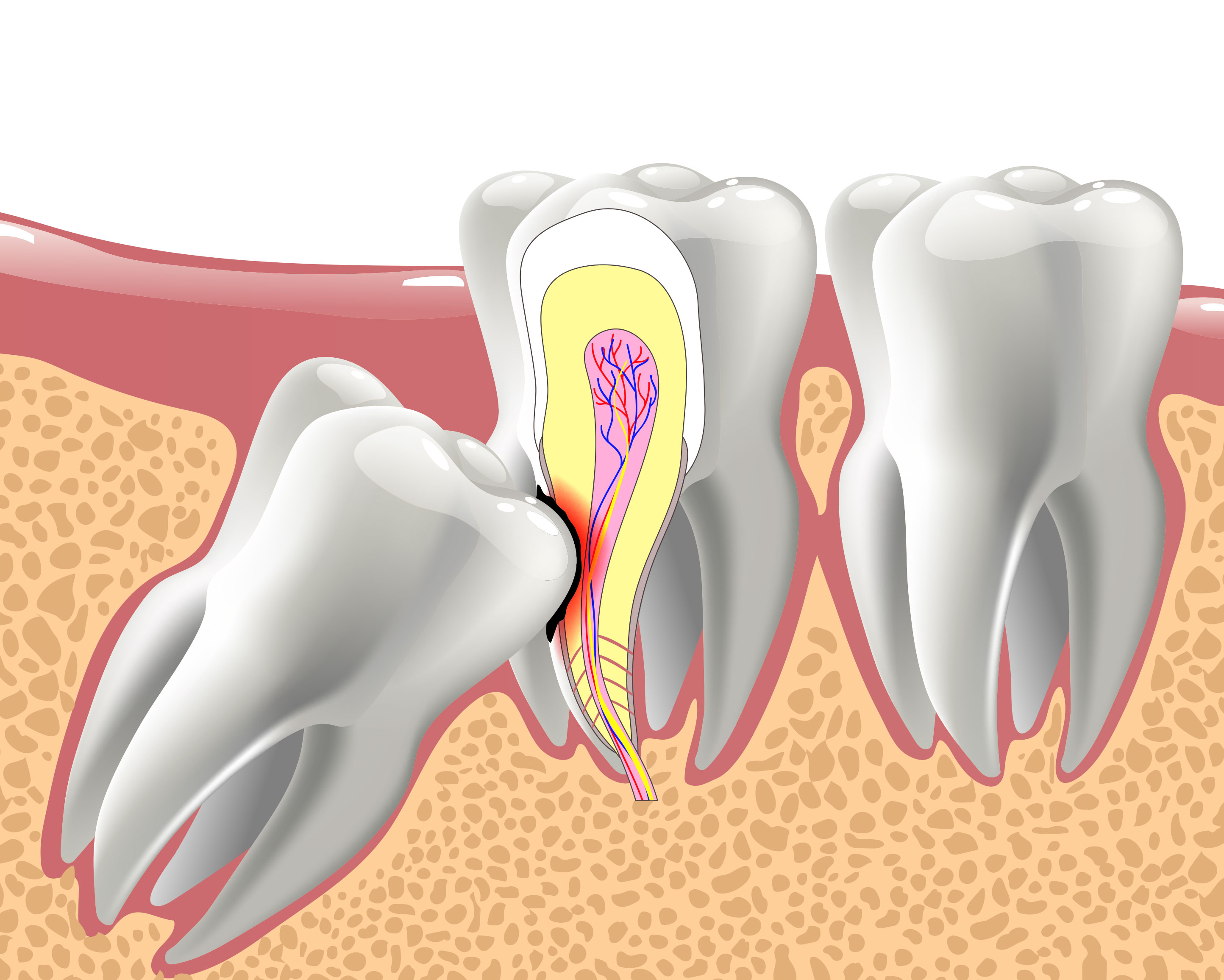 Impacted Wisdom Teeth in Miramar Beach